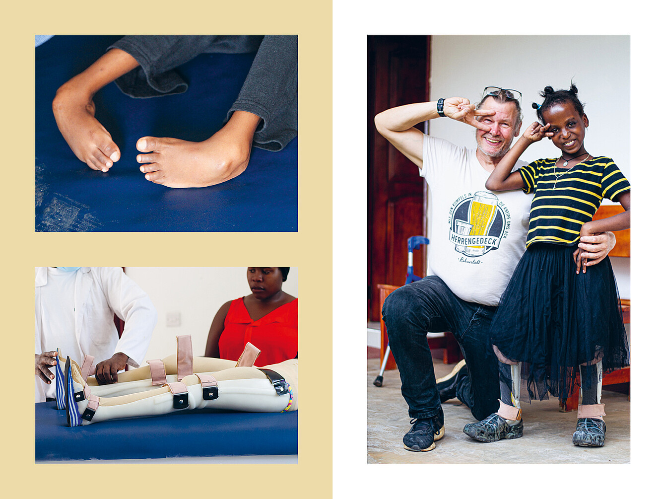 Oben links: Nahaufnahme zweier Kinderfüße auf blauem Untergrund, eines mit sichtbarer Fehlbildung. Unten links: Zwei Personen mit Prothesenbeinen auf blauem Untergrund. Rechts: Ein Mann und ein Mädchen posieren nebeneinander, beide mit Prothesen an den Beinen, der Mann trägt ein weißes T-Shirt mit Aufdruck.